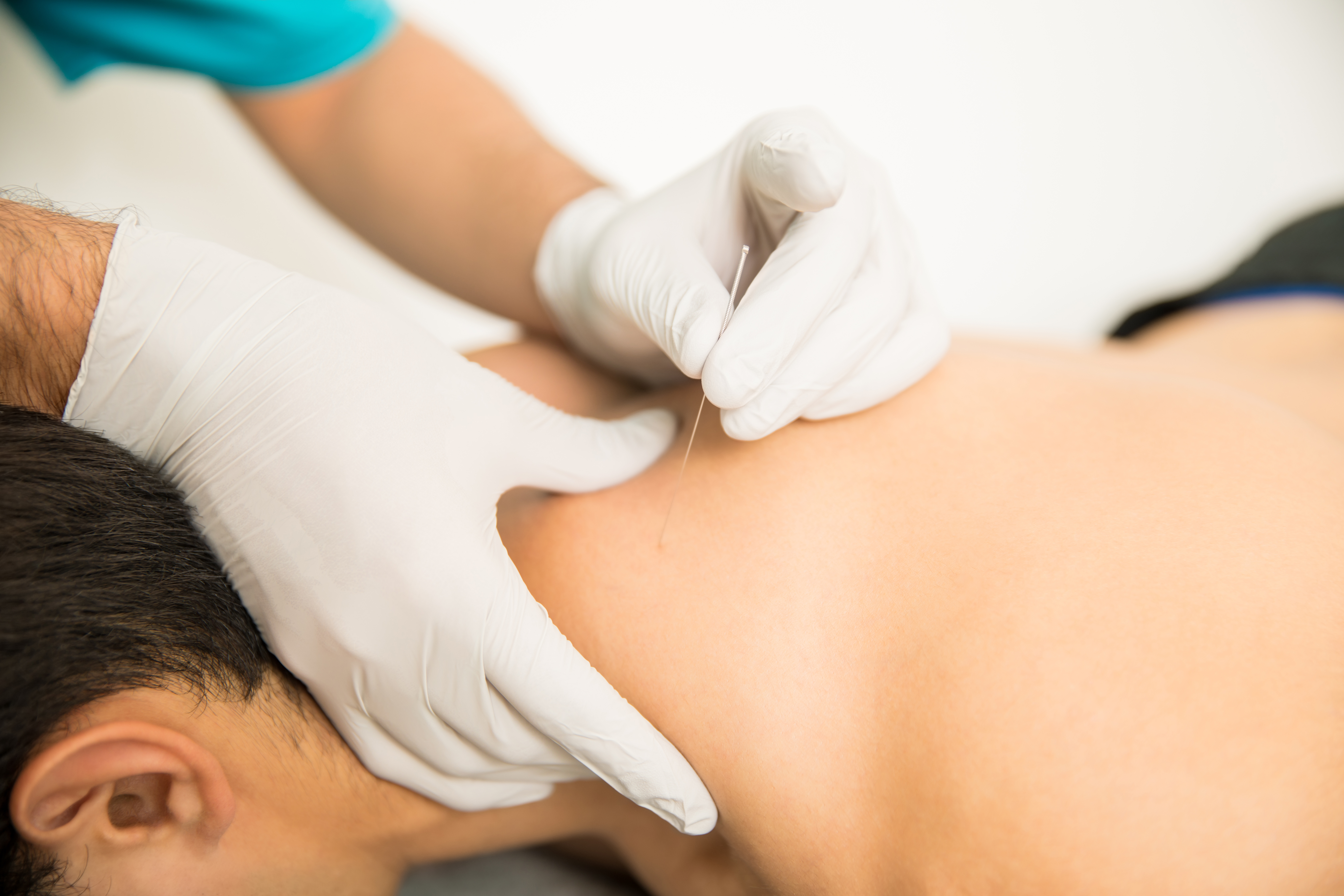 closeup-shirtless-man-receiving-dry-needling-therapy-from-doctor-clinic